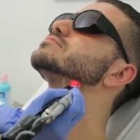 gdefh Laser Beard Shaping